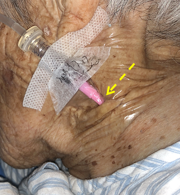 bd留置针怎么使用病人都休克了，留置针打不上怎么办？教你一招！_https://www.jmylbn.com_新闻资讯_第4张