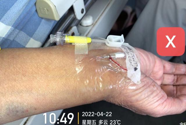 留置针怎么单手推针操作视频：留置针 3 大穿刺法，教你学会正确穿刺！_https://www.jmylbn.com_新闻资讯_第11张