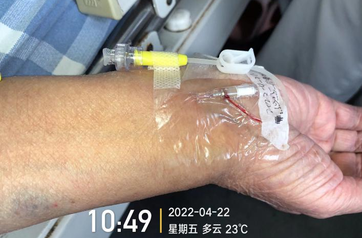 留置针怎么单手推针操作视频：留置针 3 大穿刺法，教你学会正确穿刺！_https://www.jmylbn.com_新闻资讯_第3张