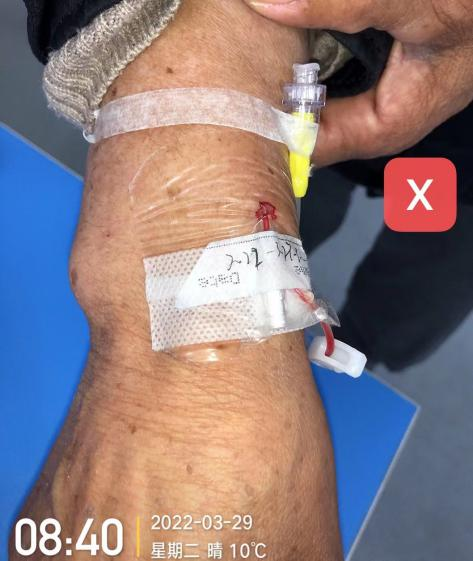 留置针怎么单手推针操作视频：留置针 3 大穿刺法，教你学会正确穿刺！_https://www.jmylbn.com_新闻资讯_第12张