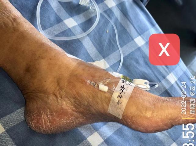 留置针怎么单手推针操作视频：留置针 3 大穿刺法，教你学会正确穿刺！_https://www.jmylbn.com_新闻资讯_第10张