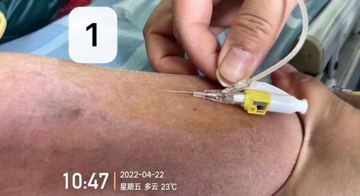 留置针怎么单手推针操作视频：留置针 3 大穿刺法，教你学会正确穿刺！_https://www.jmylbn.com_新闻资讯_第5张