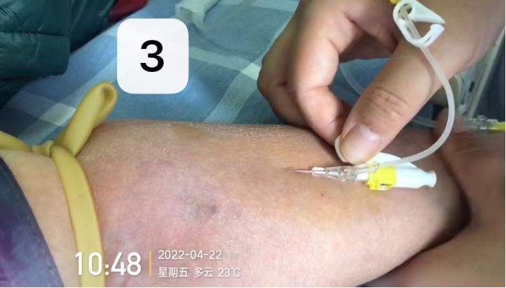 留置针怎么单手推针操作视频：留置针 3 大穿刺法，教你学会正确穿刺！_https://www.jmylbn.com_新闻资讯_第7张