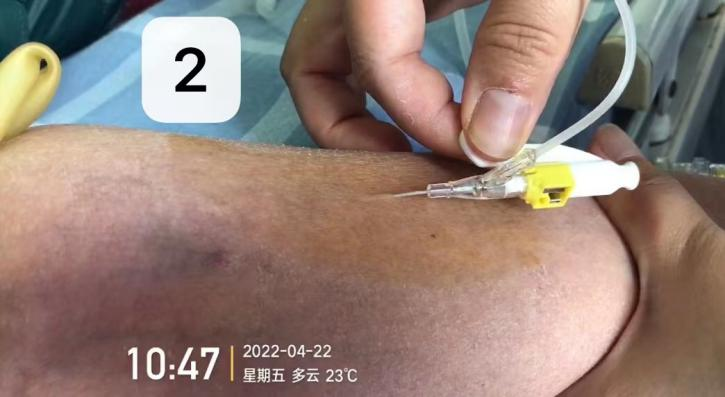留置针怎么单手推针操作视频：留置针 3 大穿刺法，教你学会正确穿刺！_https://www.jmylbn.com_新闻资讯_第6张