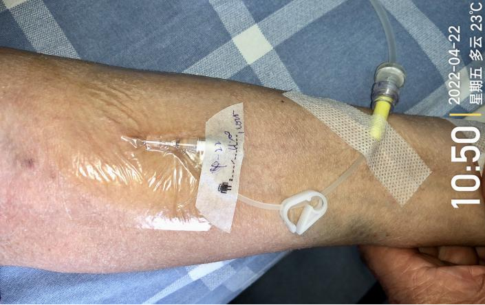 留置针怎么单手推针操作视频：留置针 3 大穿刺法，教你学会正确穿刺！_https://www.jmylbn.com_新闻资讯_第4张