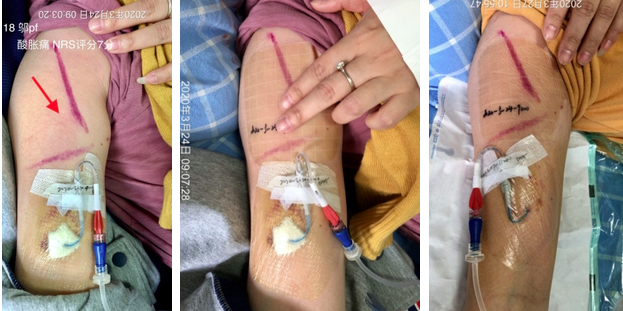 水胶体创口怎么去除创可贴的未来趋势？这个可吸收伤口污染物、促进愈合的敷料你用过吗_https://www.jmylbn.com_新闻资讯_第6张