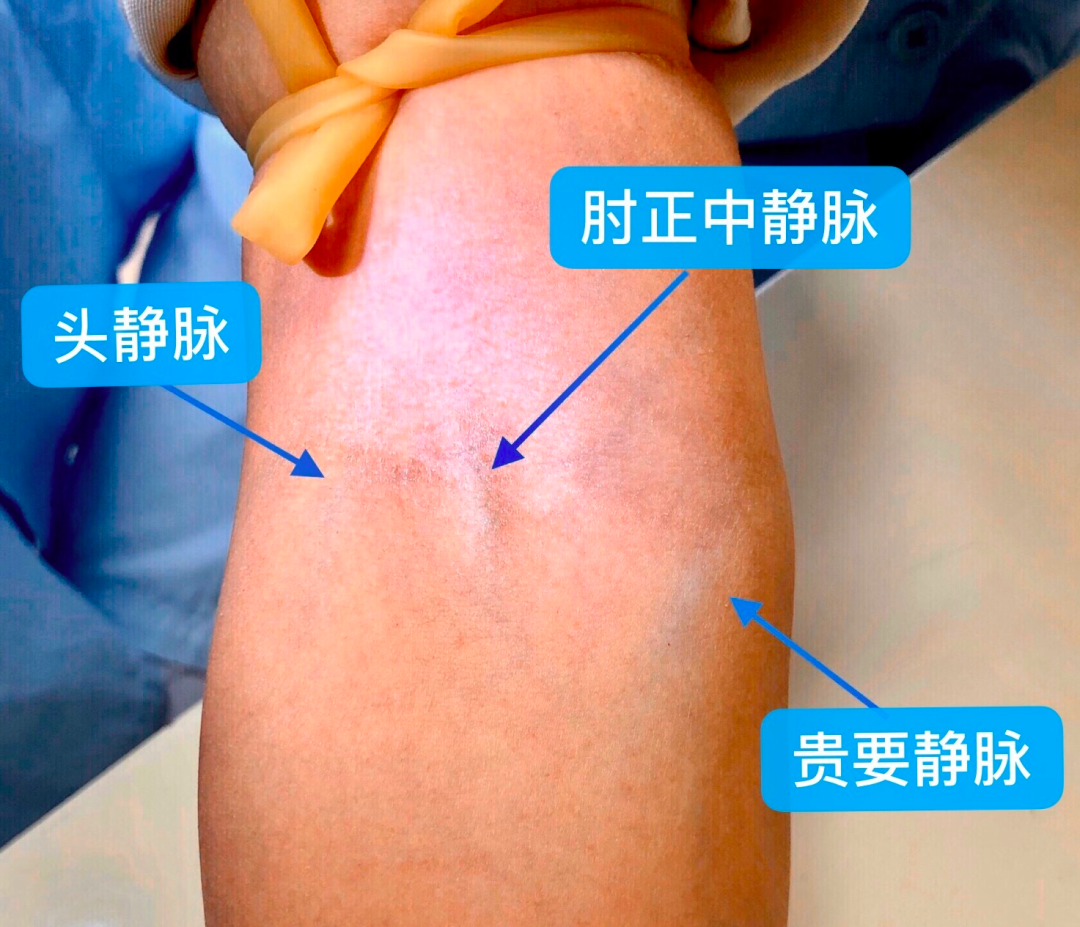 bd采血管检查什么采血管抽血顺序到底哪个先？看看那些可能被你忽略的采血问题-上海聚慕医疗器械有限公司