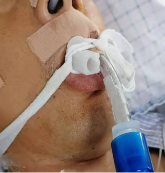 气管插管牙垫怎么放气管插管固定，没有牙垫真的不行吗？_https://www.jmylbn.com_新闻资讯_第1张