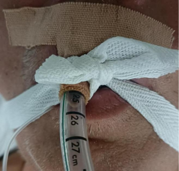 气管插管牙垫怎么放气管插管固定，没有牙垫真的不行吗？_https://www.jmylbn.com_新闻资讯_第2张