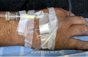 普通留置针怎么固定留置针这样固定，不出问题才怪！一文教你如何正确固定_https://www.jmylbn.com_新闻资讯_第3张