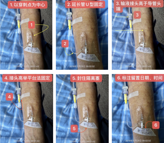 普通留置针怎么固定留置针这样固定，不出问题才怪！一文教你如何正确固定_https://www.jmylbn.com_新闻资讯_第6张