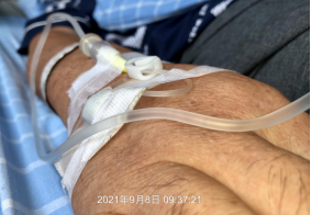 普通留置针怎么固定留置针这样固定，不出问题才怪！一文教你如何正确固定_https://www.jmylbn.com_新闻资讯_第4张