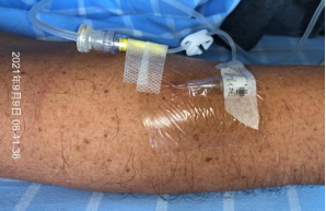 普通留置针怎么固定留置针这样固定，不出问题才怪！一文教你如何正确固定_https://www.jmylbn.com_新闻资讯_第5张