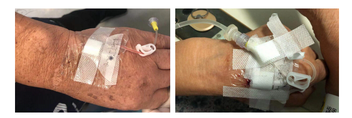 普通留置针怎么固定留置针这样固定，不出问题才怪！一文教你如何正确固定_https://www.jmylbn.com_新闻资讯_第7张