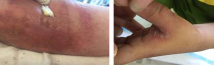 留置针绷带怎么缠儿童留置针不可使用卷绷带固定？这里有答案_https://www.jmylbn.com_新闻资讯_第10张