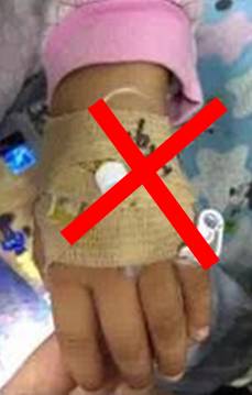 留置针绷带怎么缠儿童留置针不可使用卷绷带固定？这里有答案_https://www.jmylbn.com_新闻资讯_第3张