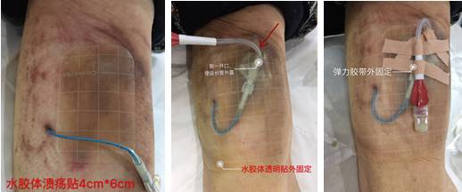 留置针绷带怎么缠儿童留置针不可使用卷绷带固定？这里有答案_https://www.jmylbn.com_新闻资讯_第9张