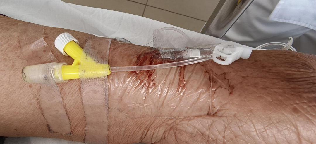 留置针怎么贴膜留置针穿刺点渗血，要不要拔针？应该这么处理！_https://www.jmylbn.com_新闻资讯_第4张