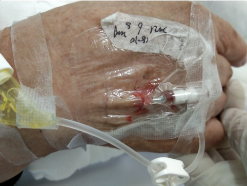 留置针怎么贴膜留置针穿刺点渗血，要不要拔针？应该这么处理！_https://www.jmylbn.com_新闻资讯_第3张