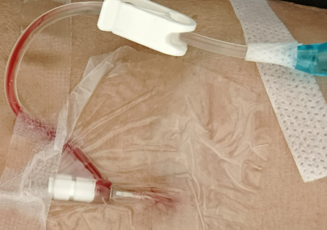 留置针怎么贴膜留置针穿刺点渗血，要不要拔针？应该这么处理！_https://www.jmylbn.com_新闻资讯_第2张