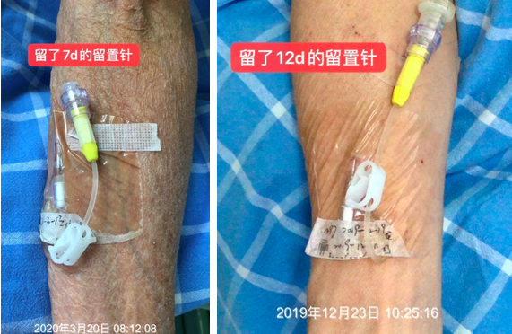 静脉留置针是干什么的为何你扎的留置针 1 天就得拔？到底是留 3 天还是 7 天？别再纠结，答案来了！_https://www.jmylbn.com_新闻资讯_第10张