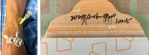 静脉留置针是干什么的为何你扎的留置针 1 天就得拔？到底是留 3 天还是 7 天？别再纠结，答案来了！_https://www.jmylbn.com_新闻资讯_第9张