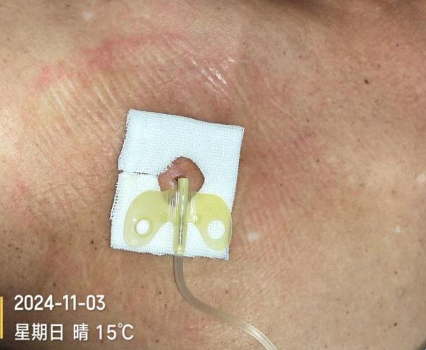 为什么输液要盖块纱布输液港维护，最容易忽视的步骤竟然是这个！_https://www.jmylbn.com_新闻资讯_第6张