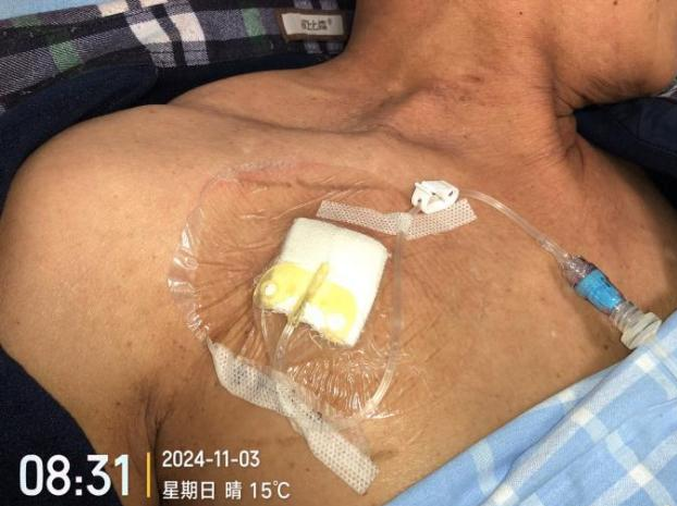 为什么输液要盖块纱布输液港维护，最容易忽视的步骤竟然是这个！_https://www.jmylbn.com_新闻资讯_第3张