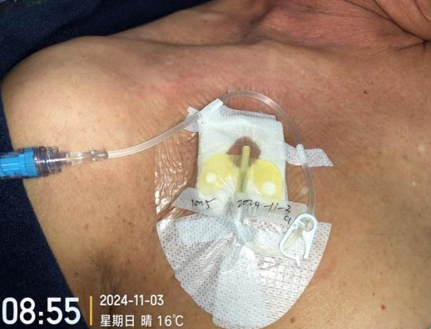 为什么输液要盖块纱布输液港维护，最容易忽视的步骤竟然是这个！_https://www.jmylbn.com_新闻资讯_第7张