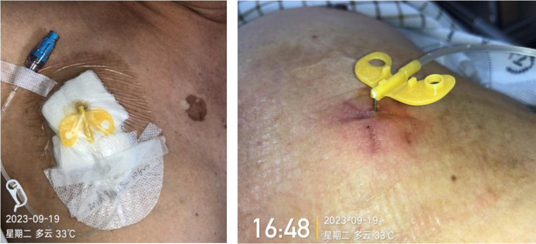 为什么输液要盖块纱布输液港维护，最容易忽视的步骤竟然是这个！_https://www.jmylbn.com_新闻资讯_第2张