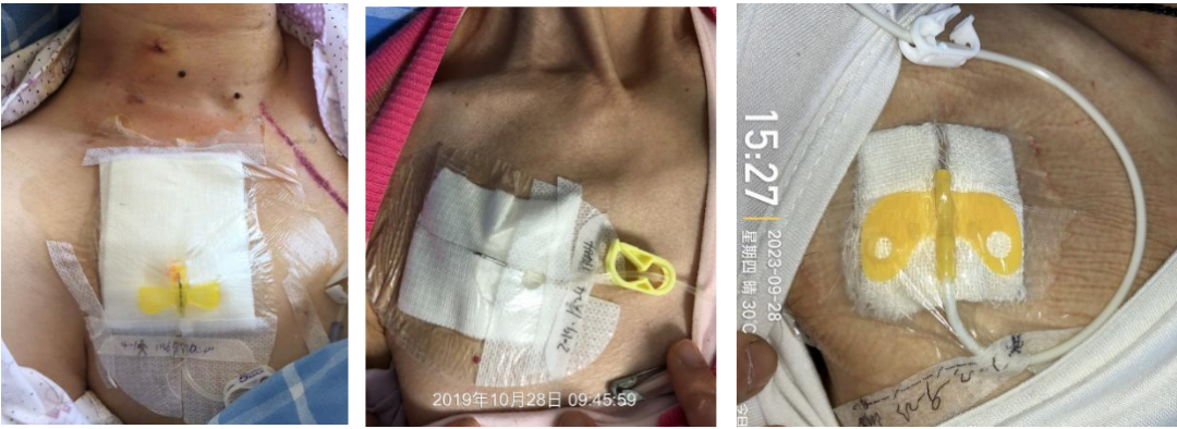 无菌纱布怎么用无菌纱布这样剪，7 天换一次敷料都稳了_https://www.jmylbn.com_新闻资讯_第1张