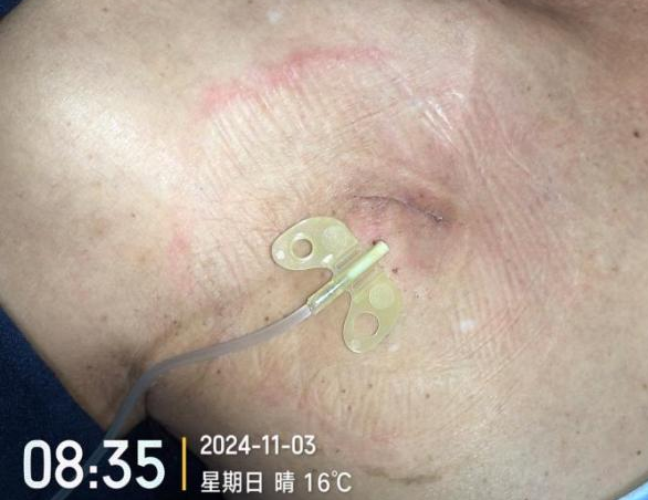 为什么输液要盖块纱布输液港维护，最容易忽视的步骤竟然是这个！_https://www.jmylbn.com_新闻资讯_第4张