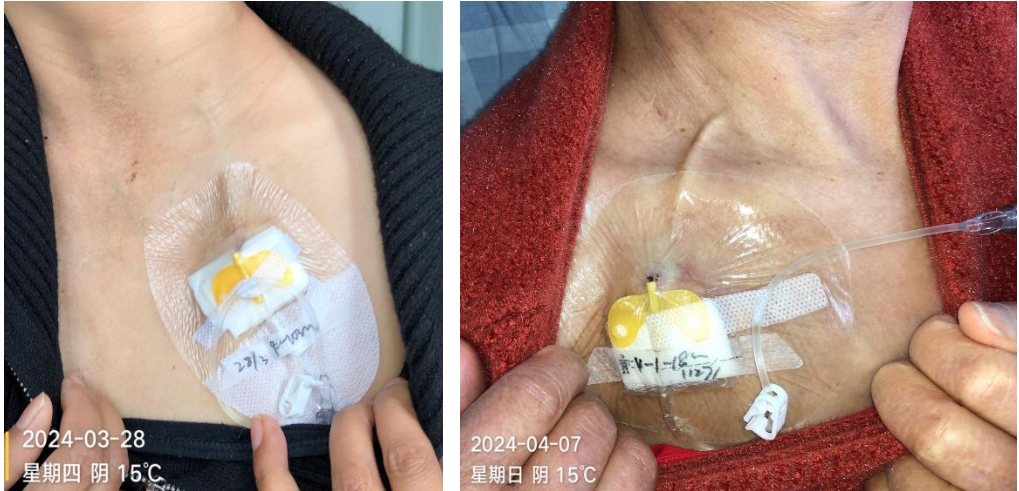 无菌纱布怎么用无菌纱布这样剪，7 天换一次敷料都稳了_https://www.jmylbn.com_新闻资讯_第8张