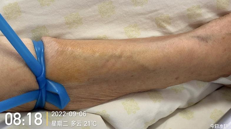 留置针怎么单手推针留置针 5 大穿刺技巧，看过的护士都收藏了！_https://www.jmylbn.com_新闻资讯_第2张