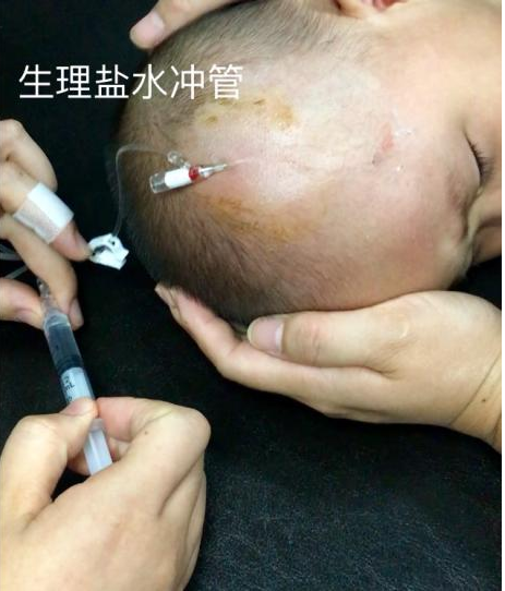 留置针怎么单手推针留置针 5 大穿刺技巧，看过的护士都收藏了！_https://www.jmylbn.com_新闻资讯_第6张