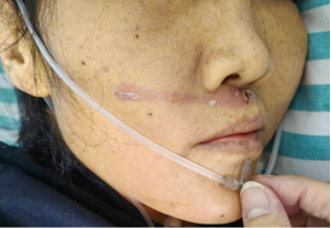 为什么吸氧管子是一边的吸氧管佩戴：塑料搭片，究竟朝上还是朝下？_https://www.jmylbn.com_新闻资讯_第6张