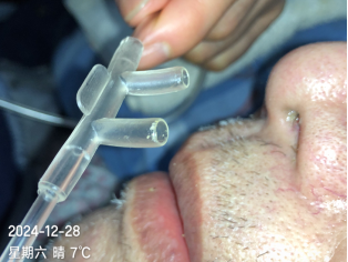 为什么吸氧管子是一边的吸氧管佩戴：塑料搭片，究竟朝上还是朝下？_https://www.jmylbn.com_新闻资讯_第2张