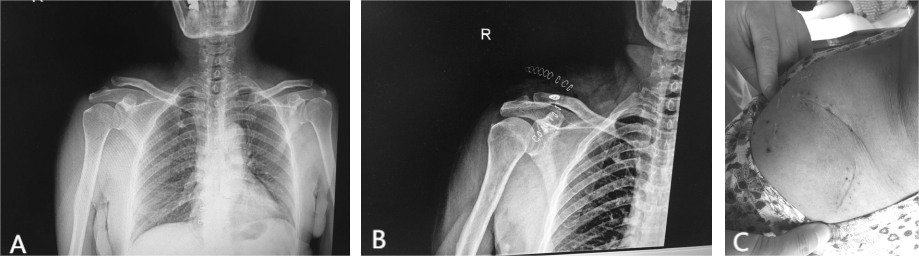 肩锁关节脱位治疗新选择：三种内固定方法，值得一看！