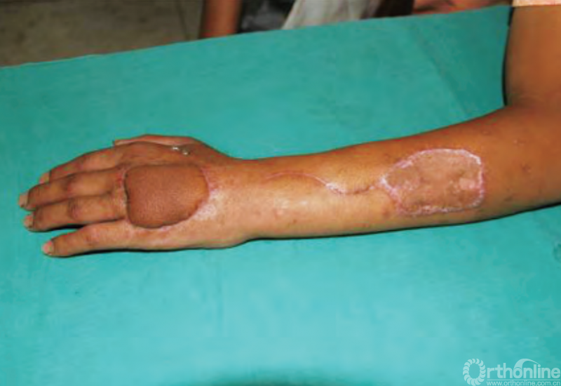 医用缝合包怎么包干货 ｜ 手把手教你缝合打包跨供区加压法修复皮肤软组织缺损_https://www.jmylbn.com_新闻资讯_第4张