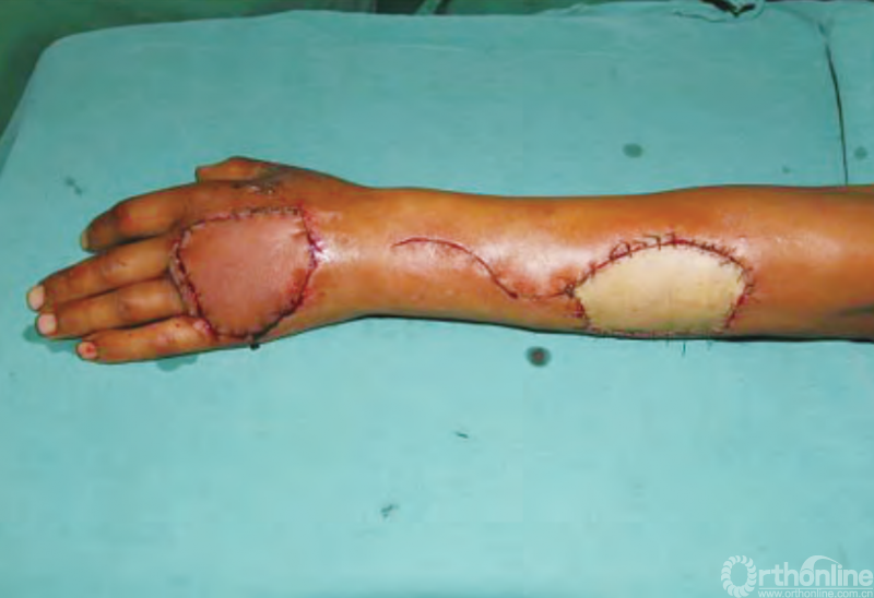 医用缝合包怎么包干货 ｜ 手把手教你缝合打包跨供区加压法修复皮肤软组织缺损_https://www.jmylbn.com_新闻资讯_第2张