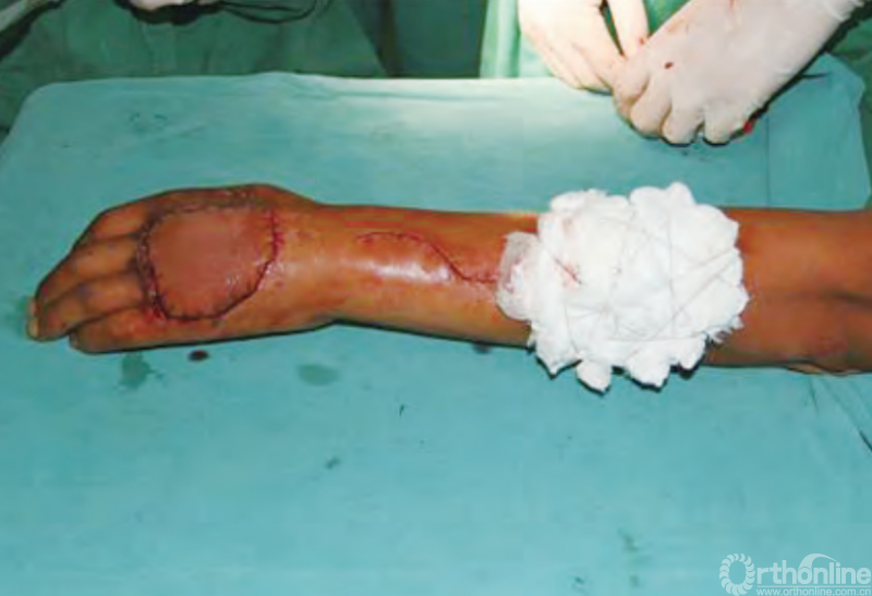 医用缝合包怎么包干货 ｜ 手把手教你缝合打包跨供区加压法修复皮肤软组织缺损_https://www.jmylbn.com_新闻资讯_第3张