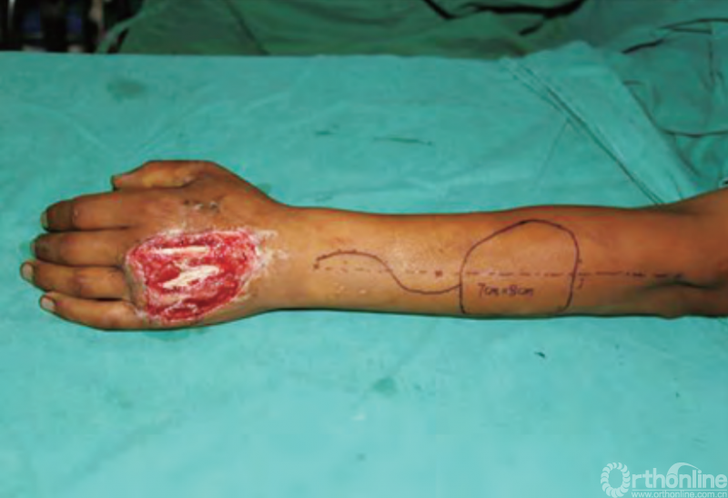 医用缝合包怎么包干货 ｜ 手把手教你缝合打包跨供区加压法修复皮肤软组织缺损_https://www.jmylbn.com_新闻资讯_第1张