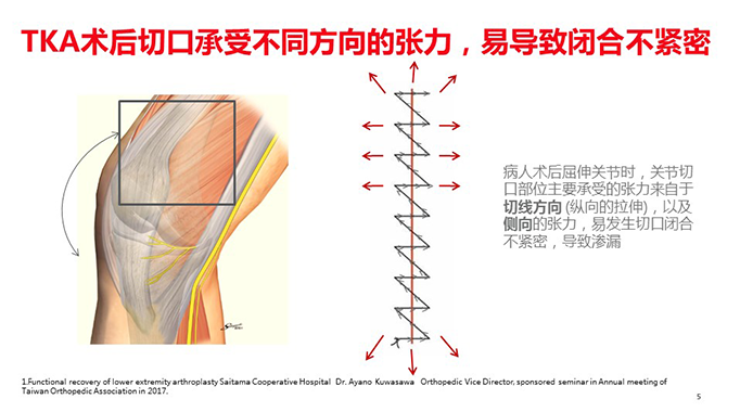 倒刺线怎么缝合鱼骨倒刺线在膝关节置换术中的应用_https://www.jmylbn.com_新闻资讯_第5张