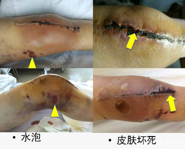 馮賓:中國血友病骨科手術圍術期處理專家共識