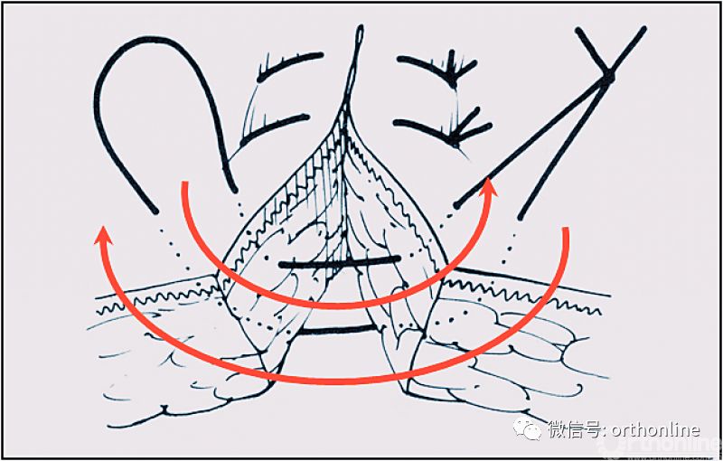 医疗缝线怎么做动图+视频，详解常见手术切口缝合技术_https://www.jmylbn.com_新闻资讯_第26张