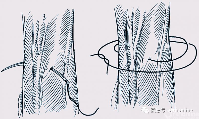 医疗缝线怎么做动图+视频，详解常见手术切口缝合技术_https://www.jmylbn.com_新闻资讯_第25张