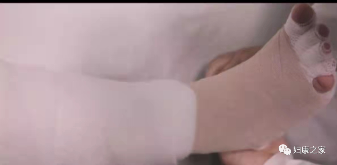 压力绷带为什么那么贵淋巴水肿知多少---CDT之压力治疗_https://www.jmylbn.com_新闻资讯_第16张