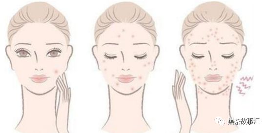 黑茶的养生效果之青春痘篇！