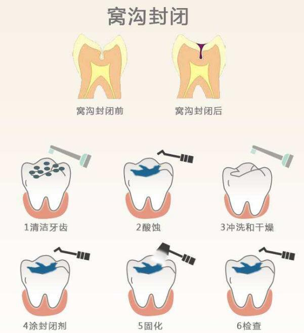 拔掉烂牙根多久才能补牙_烂牙根一般几年内必须拔_拔烂掉的牙根多少钱