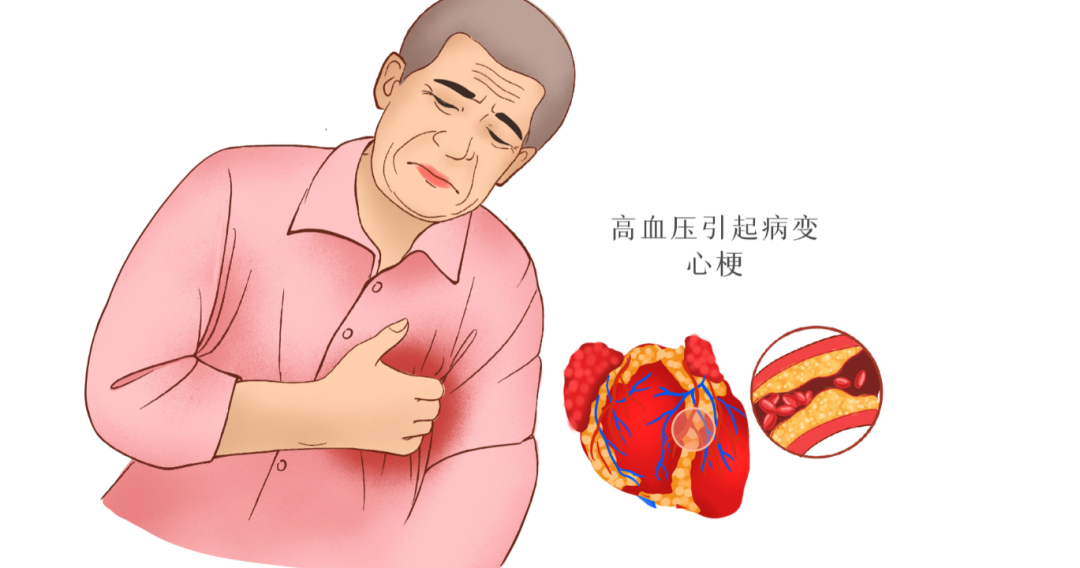 心梗的前兆有哪些症状图片